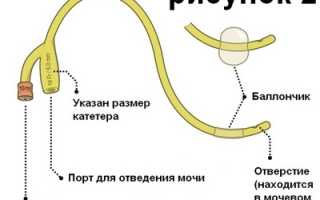 Цистостома и цистостомия мочевого пузыря – техника наложения, уход