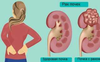Прогноз выживаемости человека на разных стадиях рака почки