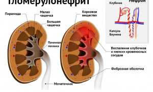 Симптоматика гломерулонефрита при беременности: лечение, профилактика и прогноз