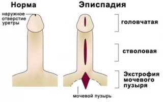 Эписпадия – что это за болезнь у детей